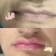 Mesoskin PINKY LIPS بينكي ليبس ومني فيلر لتوريد الشفايف 5 مل امبول