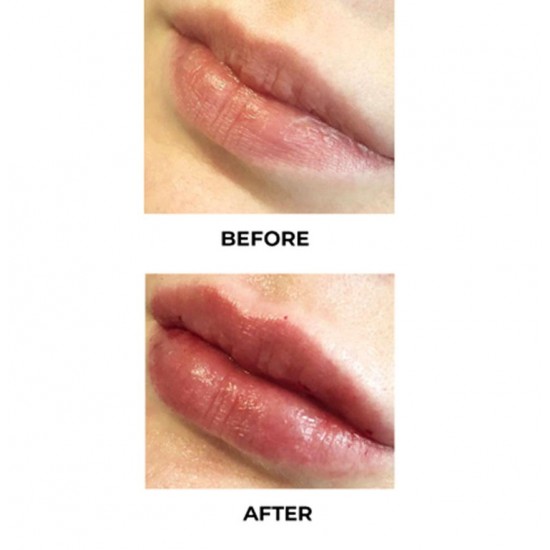 Mesogenic PINKY LIPS بينكي ليبس لتوريد الشفايف 5 مل امبول