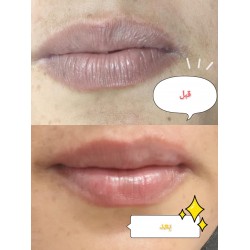 Mesoskin PINKY LIPS بينكي ليبس ومني فيلر لتوريد الشفايف 5 مل امبول